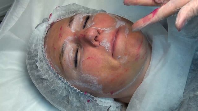 Пилинг EYE на всё лицо плюс нейтрализация смотреть онлайн