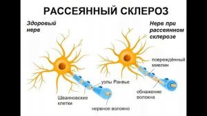 МАТРИЦА ГАРЯЕВА ДЛЯ ЛЕЧЕНИЯ РАССЕЯННОГО СКЛЕРОЗА