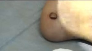 Удаление подошвенных бородавок