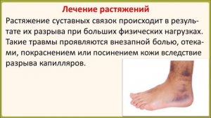 Какие мази помогают при ушибах и растяжениях?