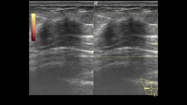 Lymph node with loss of fatty hilum, breast cancer 림프절 지방문이 소실된 유방암 смотреть онлайн