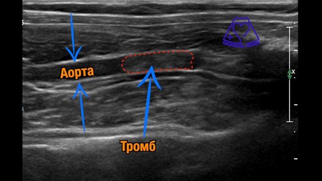 Артериальная тромбоэмболия. Тромб в брюшной аорте у кошки
