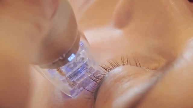 RF-ЛИФТИНГ в Омске на аппарате SCARLET смотреть онлайн