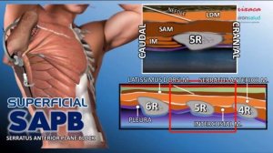 Блокада пространства передней зубчатой мышцы (SERRATUS ANTERIOR PLANE BLOCK (SAPB)