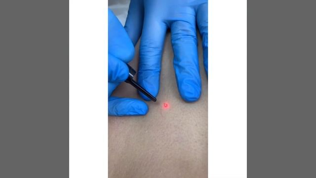 Лазерное удаление образований в процессе смотреть онлайн
