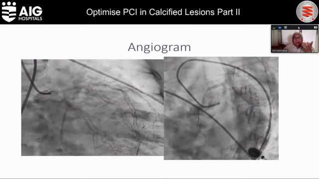 Optimise PCI in Calcified Lesions Part II | AIG Hospitals смотреть онлайн