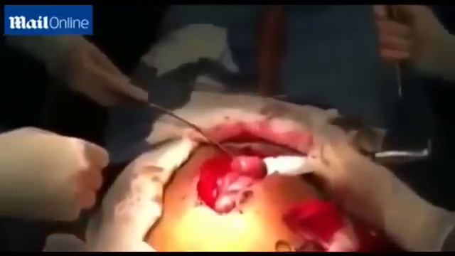 Бразильские хирурги удалили из кишечника мужчины 125-сантиметровую живую рыбу (18+) смотреть онлайн