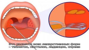 Как убрать пробки на миндалинах у ребенка