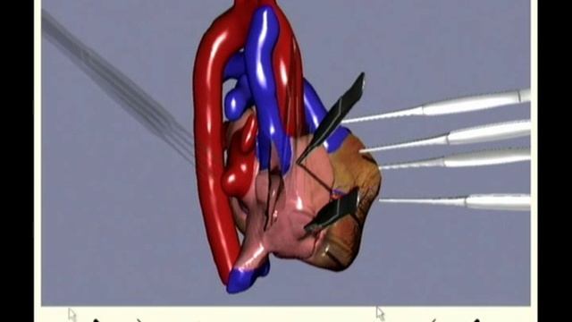 Virtual open heart surgery: training complex surgical procedures in congenital heart disease. смотреть онлайн