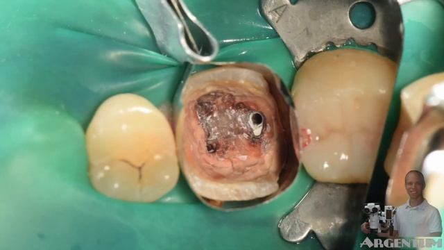 Red Russian Tooth 3.6, извлечение штифтов, смотреть онлайн