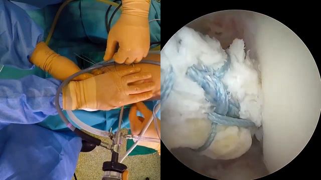 ACL Reconstruction And Modified Lemaire Tenodesis Utilizing Common Suspensory Femoral Fixation