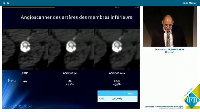 JFR 2016 : Symposium Scanner- Dr Treutenaere | GE Healthcare смотреть онлайн