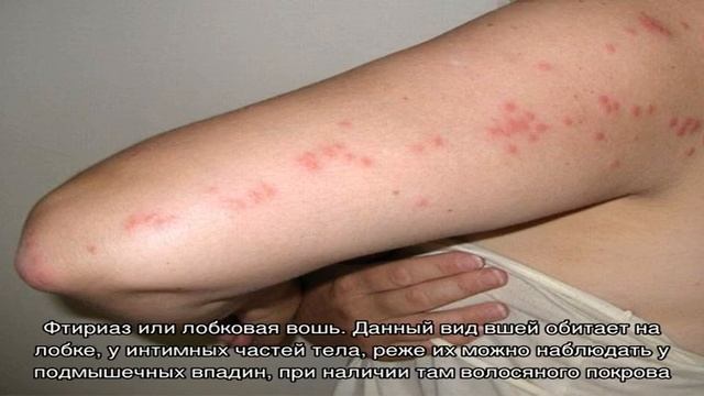 Как выглядят укусы вшей на голове смотреть онлайн