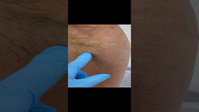 Варикоз у мужчины. Варикоз лечение. Узи вен. Лечение вен. Сосудистый хирург Москва. Флеболог Москва смотреть онлайн