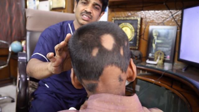 Live Trichoscopy of Alopecia Areata Patient (बालों में कीड़ा लगना) | Treatment of Patchy Hair Loss смотреть онлайн