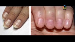 Болезнь можно узнать по ногтям