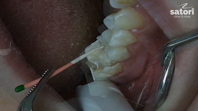 Лечение периодонтита, второе посещение. Пломбирование каналов зуба. смотреть онлайн