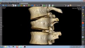 КТ КОМПРЕССИОННЫЙ ПЕРЕЛОМ L1 ПОЗВОНКА .  Перелом поперечных  остевых отростков . .