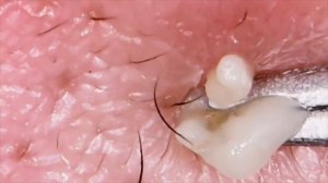 ВЫДАВЛИВАНИЕ ПРЫЩЕЙ И ЧЕРНЫХ ТОЧЕК НА ЛИЦЕ!!!!