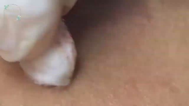 Treatment Of Blackheads And Hidden Acne #110