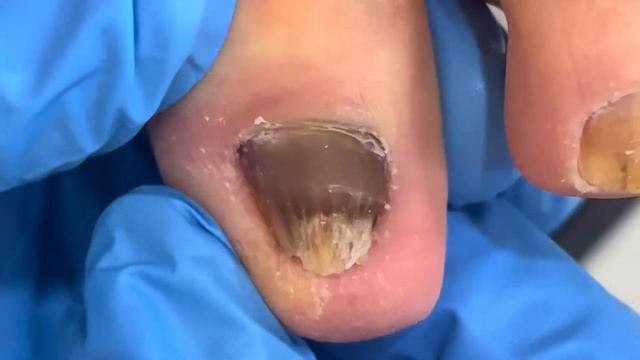 Pedicure Tutorial: The complete process of trimming onychomycosis! смотреть онлайн