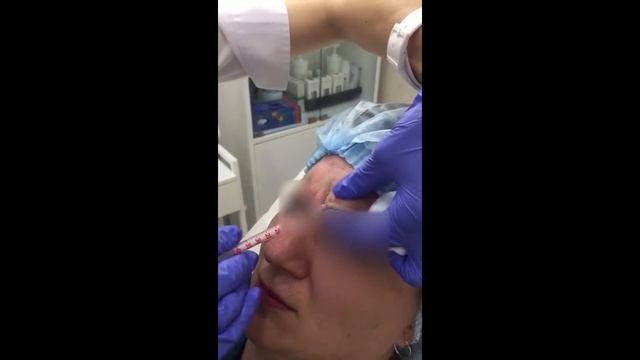 Коррекция межбровных морщин препаратом 