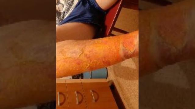 Последствия Ожога водой 90℃ будьте осторожны боль страшная смотреть онлайн