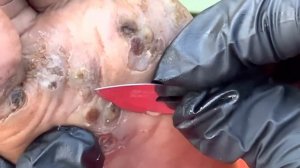 Ivyn's jigger digging - watch full video and 1000s others @riseupsociety.net