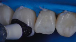 Микроабразия с использованием набора Opalustre Kit