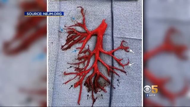 Man Coughs Up 6-Inch Blood Clot in Shape of a Bronchial Tree, Dies смотреть онлайн