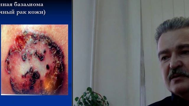 Ткач Юрий Григорьевич – врач онколог ОООД - тема: