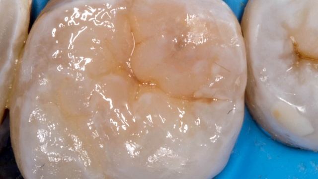 Прямая композитная реставрация зуба , поставить пломбу #стоматология #кариес #пломба #имплант смотреть онлайн