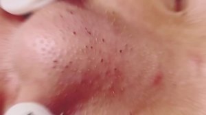 How to Remove Blackheads #acne #blackheads #removeblackheads @removeblackhead