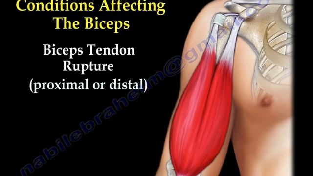 Biceps Tendon Pathology - Everything You Need To Know - Dr. Nabil Ebraheim