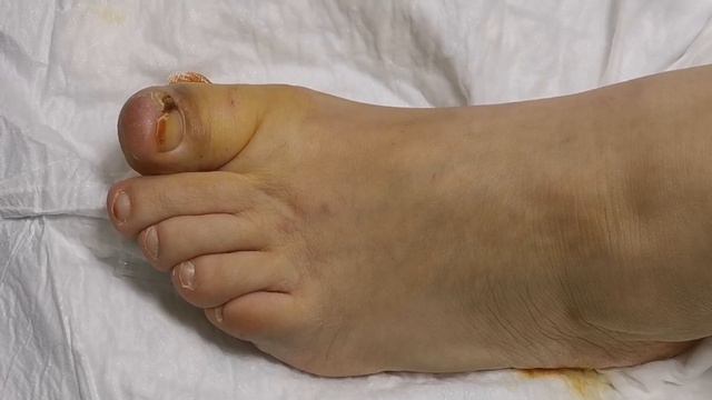 What Causes Ingrown Nails   -  Tırnak Batması Neden Olur   5 Nisan 2023