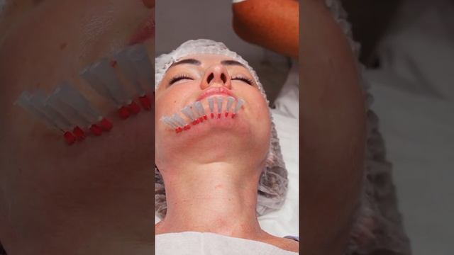 Армирование субментальной зоны мезонитями Twin / Косичка