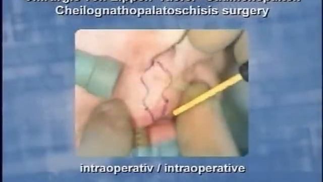 Other_radiosurgery.wmv