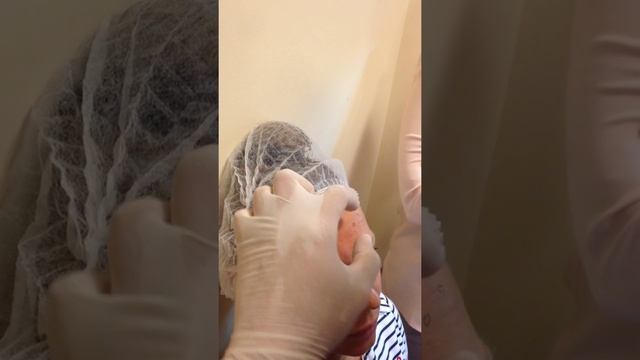 Ботокс студенты практика область лба