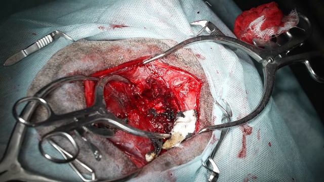 Новообразование головного мозга. смотреть онлайн