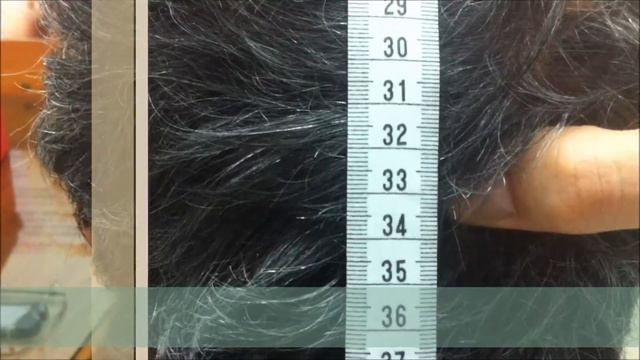O.T. Metodo D'Ambra - Pz.108 - Increase scalp laxity, first treatment. Piero Tesauro Clinic. смотреть онлайн