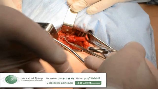 Флебэктомия