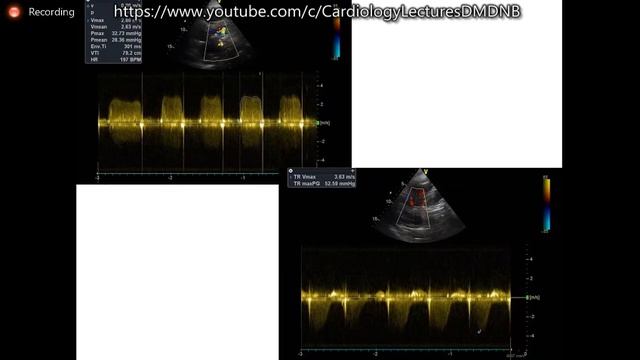 Basic Echocardiography in ED Dr RJM Friday Classes 4th June 2021 смотреть онлайн