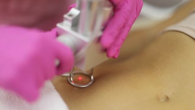 СО2 лазерная шлифовка смотреть онлайн