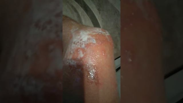 Кислотный сок. Последствия ожога. смотреть онлайн