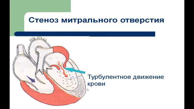 13:50 Приобретеные пороки сердца смотреть онлайн