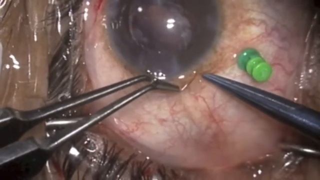 IOL exchange with advanced optic capture and pars plana vitrectomy by Steven G. Safran MD смотреть онлайн