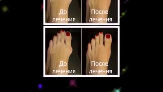болит нога опухла косточка смотреть онлайн