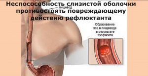 Чем опасна ИЗЖОГА? ГЭРБ. Причины. Симптомы. Лечение.