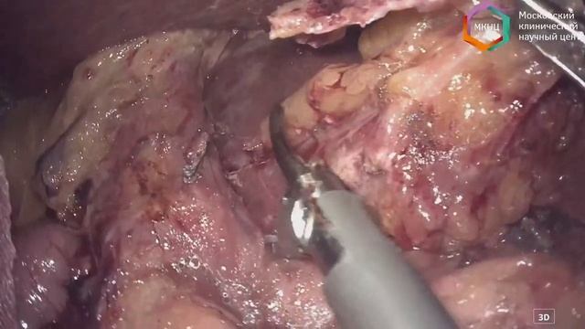 Лапароскопическая дистальная резекция желудка с D2 лимфаденэктомией