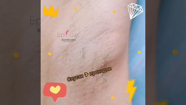 Электроэпиляция смотреть онлайн